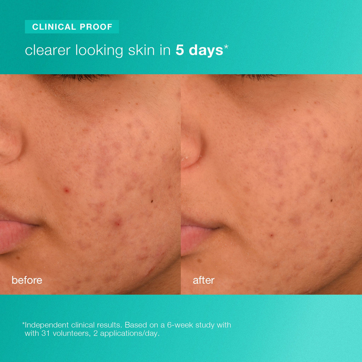 acne biotic moisturizer