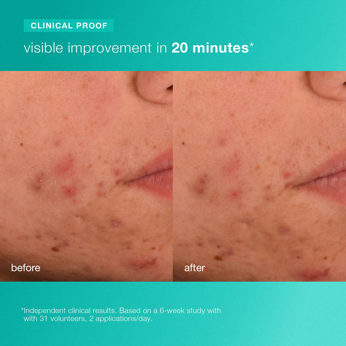 acne biotic moisturizer